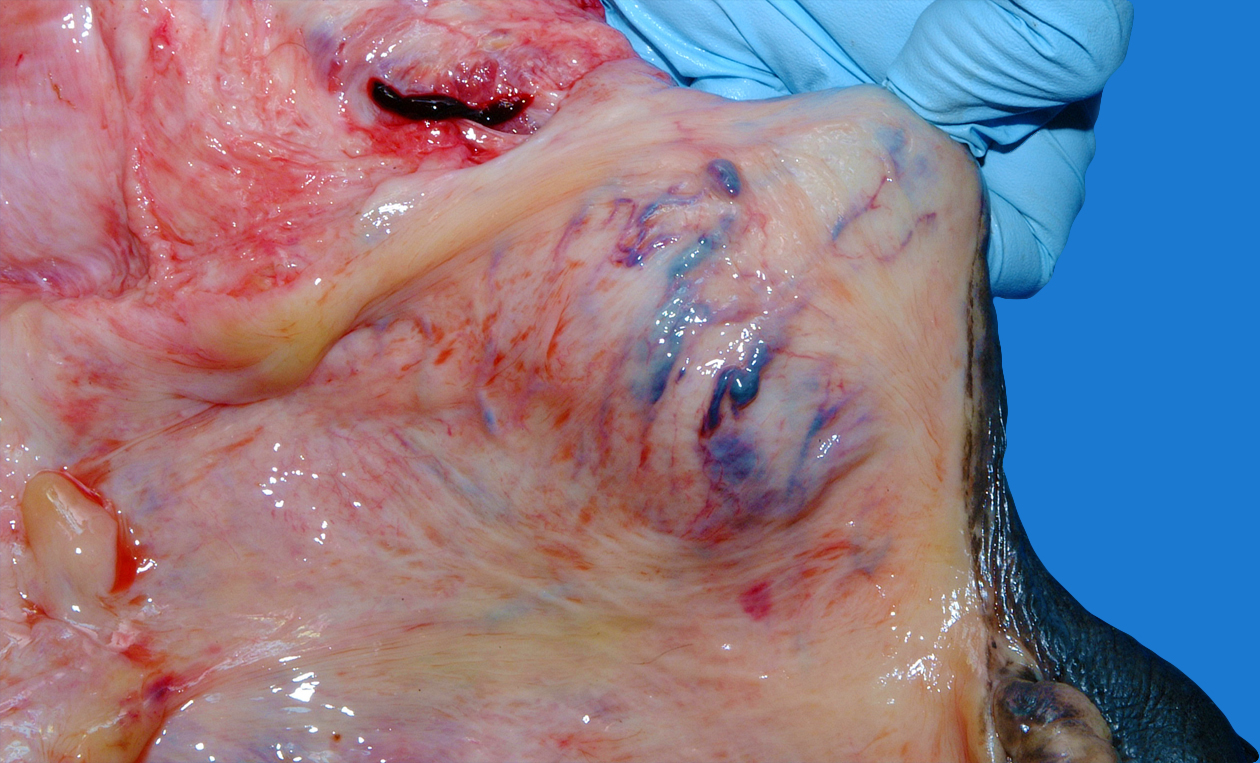 Vulva varicose vains That can Vulva varicose vains